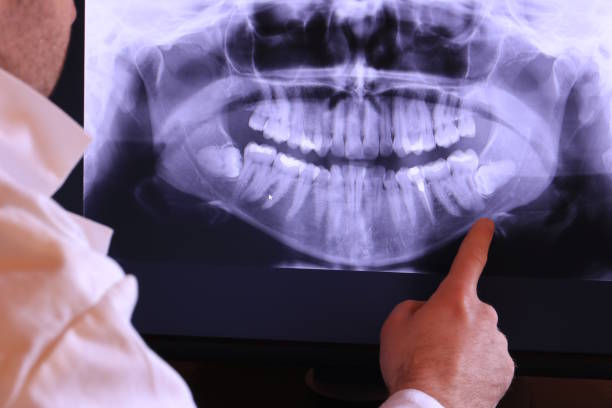 Best Emergency Dental Extractions in Oswego, IL